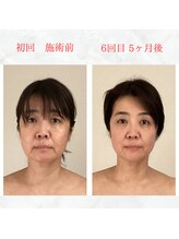 リラココ(リラcoco)/ビフォーアフター（50代お客様）