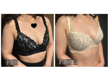 リルマコ/バスト症例写真