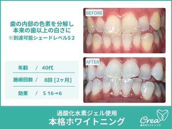 クレア(Crea)/【ホワイトニング症例写真】
