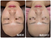 カシェット(Cachette.)の雰囲気（2回の施術でこの肌のツヤ、トーンアップを実現！）