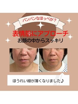 ブランソワン/ほうれい線が薄くなりました