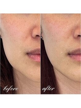 シーズボーテ(C's Beaute)/リフトUPフェイスラインスッキリ