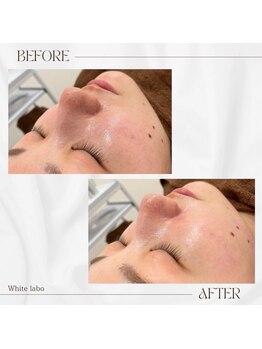 ホワイトラボ 梅田(White labo)/毛穴のお掃除!大人気毛穴洗浄☆