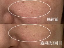 キーオブフェイス(Key of Face)/お悩み【毛穴の開き】