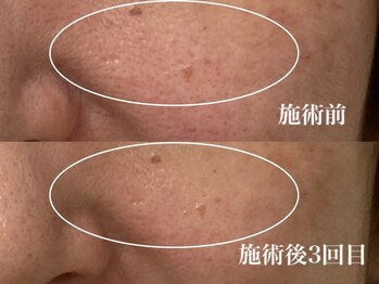 キーオブフェイス(Key of Face)/お悩み【毛穴の開き】