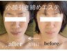 【小顔エステ】低周波でたるみケア&美白 ¥10000→¥8000