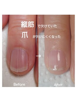 シッカネイル(sicca nail)/いつも欠けていた爪が...