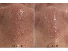 【毛穴悩み】開き・詰まり・黒ずみをケアするオーダーメイドフェイシャル