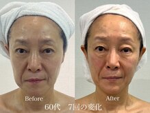 グランディールスイート(GRANDIR suite)/FACE MAKER施術結果