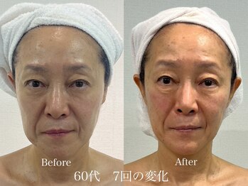 グランディールスイート(GRANDIR suite)/FACE MAKER施術結果