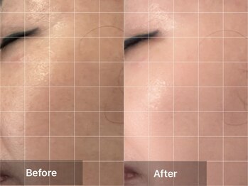 ミルジュ(MiLuJu)/マーメイドセル　Before＆After 