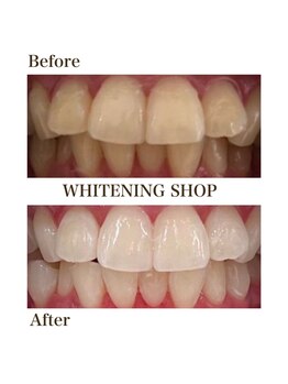 ホワイトニングショップ 大分店/Before&After美白ホワイトニング