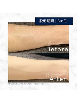 メンズクリア 沼津イーラde店/【メンズクリア】お客様の施術例