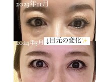 マノマノ エミュー(manomano emu)の雰囲気（つや玉小顔フェイシャル　50代オーナーの変化施術回数１３回）