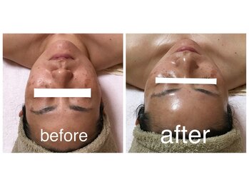 アンジュブリアン(Ange brillant)/インディバフェイシャル1回