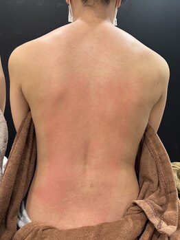 スパチャーレ(Spa ciare)/トーンヌール貼布後