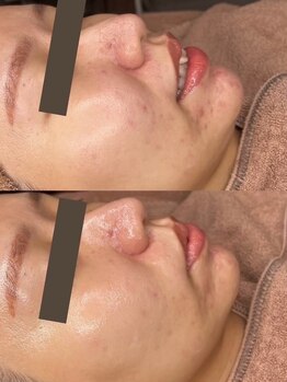 ホワイトアクア 池袋店(WHITE AQUA)/ララピールでニキビケア/池袋