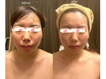 アンジュ/ハイパーナイフ小顔フェイシャル