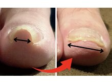 巻き爪矯正メニューございます◎