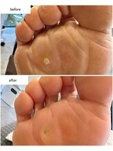 ケアプラス(care plus)/ウオノメケア