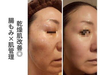 ソルレ 宮崎店(SOLURe)/乾燥肌改善 腸もみ×肌管理