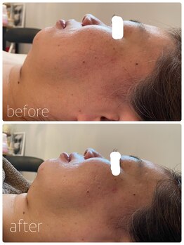 private salon KANASAの写真/フェイスラインのもたつきを撃退して引き締まった上向き小顔へ☆自信の表情