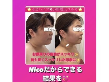 ニコ 岐南本店(Nico)/小顔★Before→after