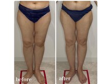 カプリス(CAPRiCE)/リンパドレナージュ