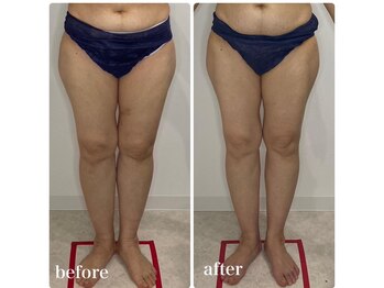 カプリス(CAPRiCE)/リンパドレナージュ