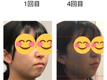 ベル/20代の方の小顔Before After