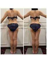 心斎橋 ルヴィ(REVI)/ボディ/痩身エステ/ダイエット