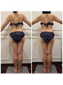 心斎橋 ルヴィ(REVI)/ボディ/痩身エステ/ダイエット