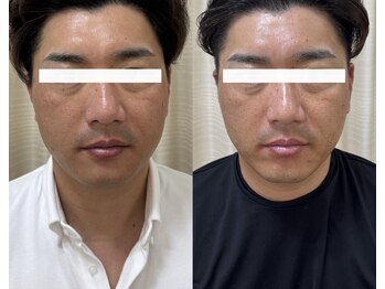 ルビーミー(Ruby's Me)/美顔筋テラボーラー症例