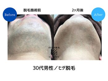 メンズアメリ/高知/メンズ脱毛/ヒゲ/全身/VIO