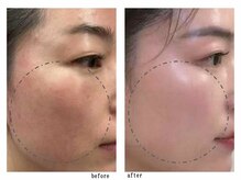 天然由来成分のピーリング剤を使用した、オリジナル肌質改善