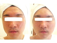 サロンドエステケイワイ(de KY)/たった１回で縦長の輪郭が卵型に