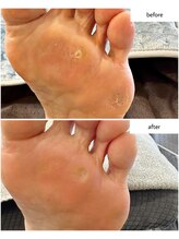 ケアプラス(care plus)/タコ・ウオノメケア