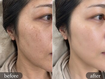 ルネル(Lunelle)の写真/繰り返す肌悩みに。結果を追求する毛穴・ニキビケア