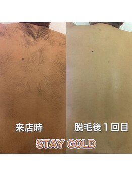 ステイゴールド 新百合ヶ丘(STAY GOLD)/自分で見えない背中脱毛!人気!
