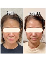 小顔22 ボルティ 本店(Bolty)/Before→After（10回）