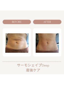 ユウキ(yuuki)/サーモシェイプDeep産後ケア