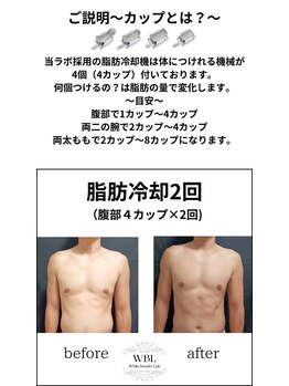 ホワイトビューティーラボ(White Beauty Lab)/【痩身】脂肪冷却お腹４カップ