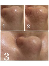 いちご鼻対策に徹底毛穴洗浄が人気です！