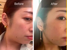 アノマリー 六本松店(Anomaly)/速攻 "小顔" 効果◎レモンボトル