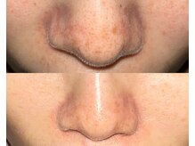 ル シーニュ/毛穴エクストラクション