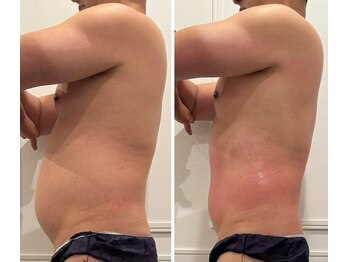 心斎橋 ルヴィ(REVI)/ボディ/痩身エステ/ダイエット