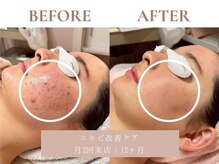 サエラ(SAERA)/ニキビ改善ケア【24回】