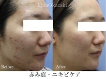 エピア 岡崎店(Epia)/赤み痕・大人ニキビケア