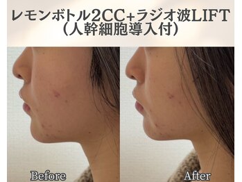 イーラボ 池袋店(e-LABO)/レモンボトル+ラジオ波Lift