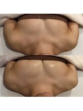 マイントゥー(mine too)/バストUP症例